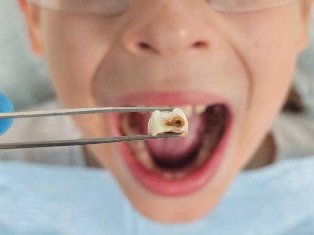 Best Emergency Dental Care for Broken or Chipped Teeth in Cologne, NJ